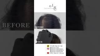 정수리두피문신 자연스러운 모발밀도보강 콤마더문 확실한 탈모커버 SMP두피문신!