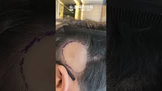 원형탈모 과잉 치료는 금물! 90% 자연회복되지만, 아닐 경우엔 흉터 재건 모발이식합니다! #shorts  [참닥터의원]