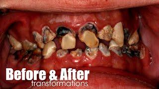 Before & After Smile Makeover Transformations By Luke Kahng