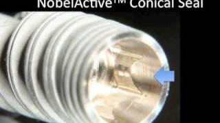 Dental Implant  - Dr. Scott MacLean - NobelActive Prosthetics