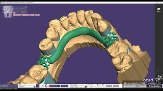 Upper Partial Denture #designing