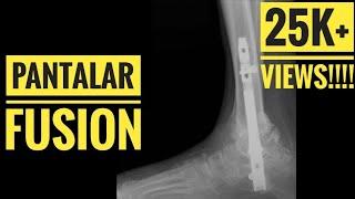 Tibiotalocalcaneal (TTC) Arthrodesis (Pantalar Fusion)