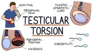 Understanding Testicular Torsion