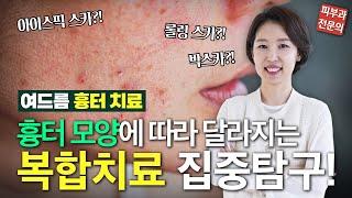 여드름 흉터 치료, 형태에 따라 그 치료법이 다르다? #피부진심닥터찐최혜진