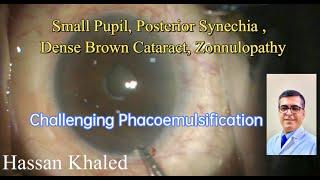 Phacoemulsification , Many Challenges in One Case