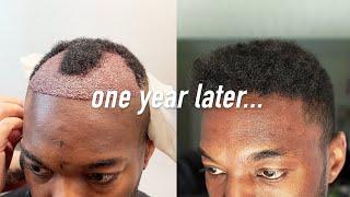 1 Year Istanbul, Turkey FUE Hair Transplant Results | I AM RIO P.