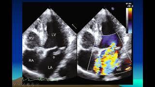 Valvular Regurgitation By  Dr Navin  C Nanda