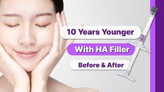 [MiFill Deep] 10 Years Younger with HA Filler!!!