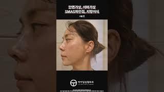 안면거상 수술 전 • 수술 10일 후 비교해보기!