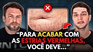 COMO SUMIR COM AS ESTRIAS VERMELHAS DE UMA VEZ? | Muzy Explica