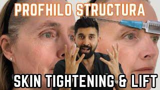 Profhilo Structura | What is it | Face Lift & Wrinkle Free | Is it better than Profhilo