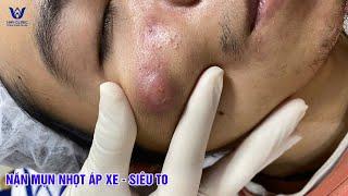Nặn mụn nhọt áp xe gò má - Cam kết hết mụn, không để lại sẹo.