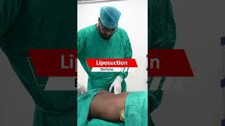 Six Pack Abs surgery | Six Pack Abs surgery Result | Liposuction cost #shortvideo #shots