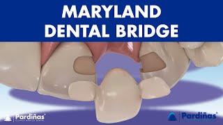 MARYLAND bridge - A DENTAL BRIDGE alternative for missing teeth ©