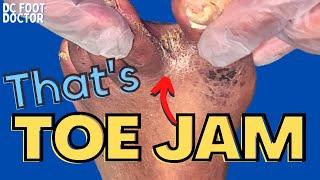 That's Toe Jam! The Build-up Between Toes Explained, Trimming Of Fungal Toenails, and Skin Scales