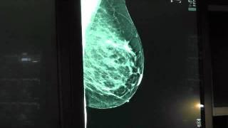 Why are Mammograms important?