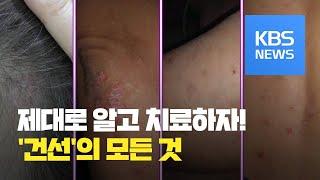 [똑! 기자 꿀! 정보] 혹시 당신도 ‘건선’? 제대로 알고 치료하자! / KBS뉴스(News)