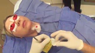 Smart Lipo on the Neck - The GoPro Cosmetic Surgeon