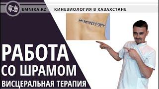 Работа со шрамом. Висцеральная терапия, кинезиология