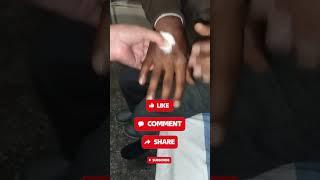 How to remove cannula #remove cannula #shorts #shortsfeed