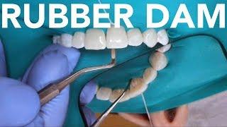 Rubber Dam Placement for Anterior & Posterior Teeth