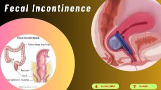 Fecal Incontinence Management
