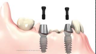 3 unit Bridge on implant abutments