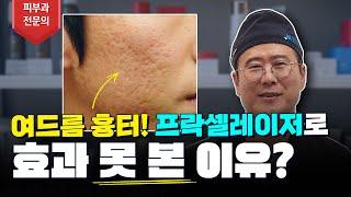 여드름흉터 프락셀레이저로 효과가 없는 이유!? (feat 프락셀 레이저, 서브시전) #여드름흉터프락셀 #여드름없애는방법