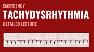 Tachydysrythmias - Emergency Medicine - Detailed explanation