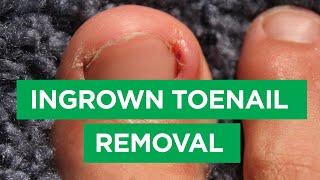 Ep. 59: Ingrown Toenail Removal Procedure | The Scope