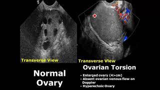 Ovary Ultrasound Normal Vs Abnormal Image Appearances | Ovarian Pathologies On USG