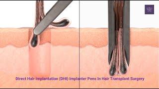 Implanter Pens In Hair Transplant Surgery