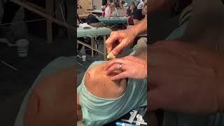 “ Dry needling” vs electroacupuncture demonstrated.