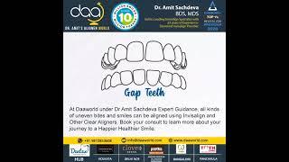 Invisalign and Other Clear Aligners.