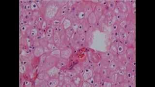 Clear Cell and Chromophobe Renal Cell Carcinoma