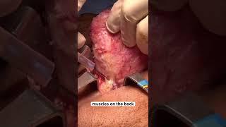 Large Lipoma Removal