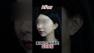 페이스+이중턱 실리프팅 리얼 후기🫶 #실리프팅 #실리프팅후기 #리프팅시술 #피부과시술 #실리프팅전후 #shorts #skincare #beauty #청담엔샤인의원