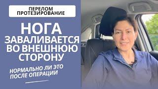 После операции, нога заваливается во внешнюю сторону. Нужно ли что-то делать?