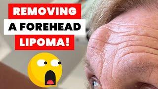 REMOVING A FOREHEAD LIPOMA!