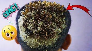 OMG!! Lots of Tiny Worms On Dandruff Removal #1151