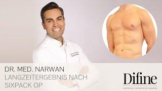 Langzeitergebnis nach Sixpack OP  | ‍️ Dr. Narwan in Essen - Difine