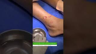 Punch grafting vitiligo surgery treatment at Skinaa clinic #punch_grafting #vitiligo_surgery #shorts