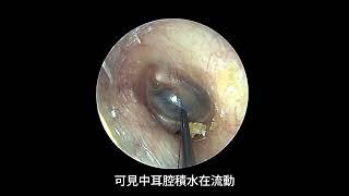 中耳積水執行耳膜穿刺抽吸。 Tympanic aspiration for a patient of otitis media with effusion.