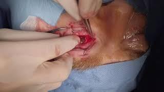 Evisceration with PMMA Implant