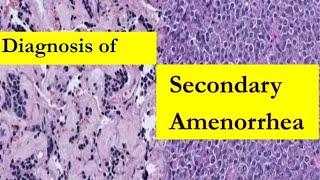 Diagnosis of Secondary Amenorrhea | Obstetrics and Gynaecology