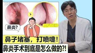 【Q&A】鼻炎手术/美容鼻前必看视频！关于鼻炎手术的全部介绍！