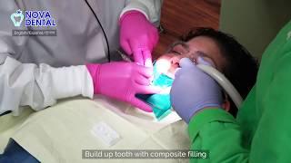 [Nova Dental Arlington] Composite Filling by Dr. Hawoon Kim