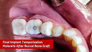 IDR - Immediate Dentoalveolar Restoration Case - Part2 - Brazil Oct-2020