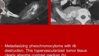 Whole Body Computed Tomography Chest Wall video book lecture