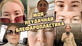 БЛЕФАРОПЛАСТИКА / моя история/ мой опыт/ блефаропластика азиатских век/ ny.zarina